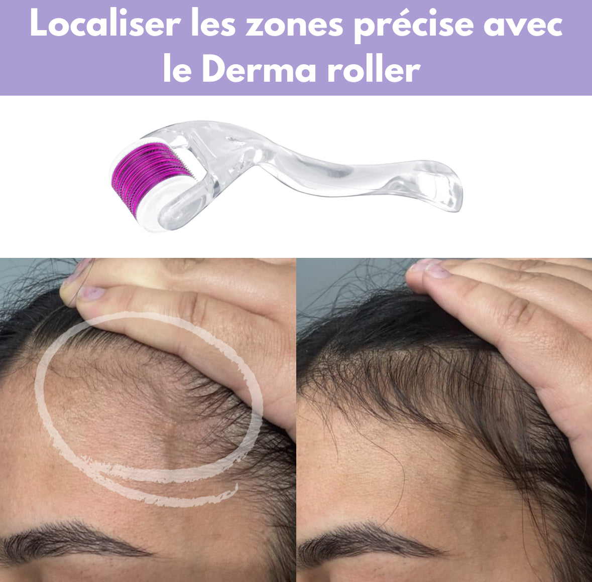 Derma Roller